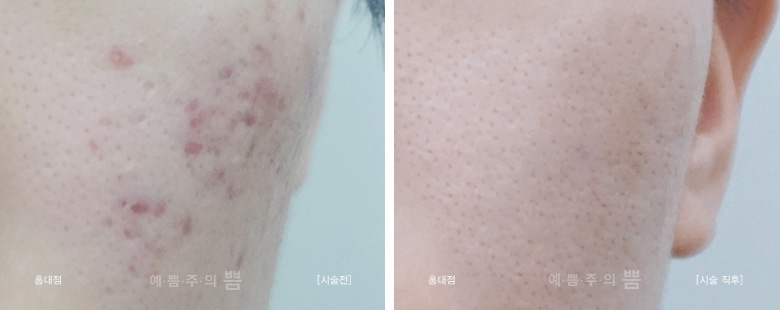 홍대점_여드름시크릿패키지