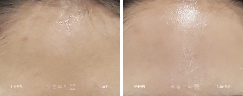 신논현점_시카레이저