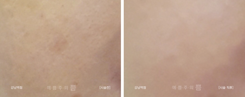 신논현점_피코토팅+아틀라스