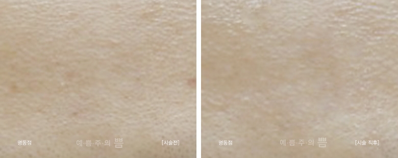 명동점_피코토닝+빛타민
