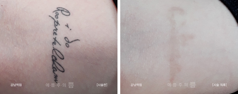 문신제거