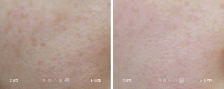명동점_피코토닝+V레이저+관리