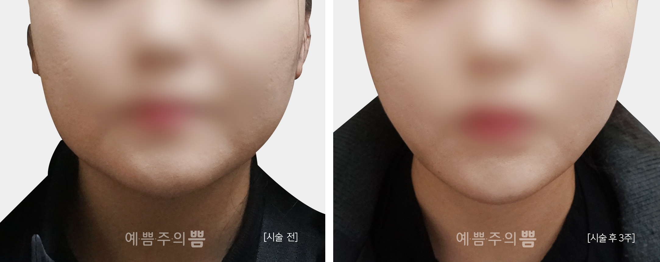 신사점_윤곽주사 3회
